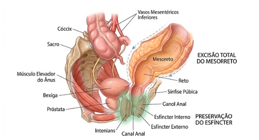 Câncer de reto: do diagnóstico à cirurgia, o que realmente esperar do tratamento