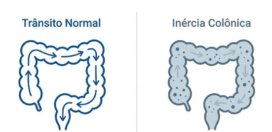 Como tratar a inércia colônica e devolver o movimento ao intestino
