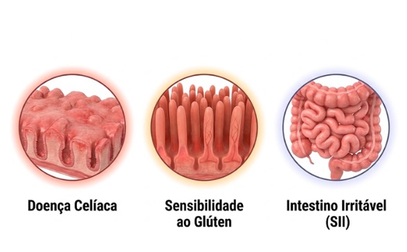 Doença celíaca: entenda a condição autoimune e saiba como recuperar a saúde intestinal