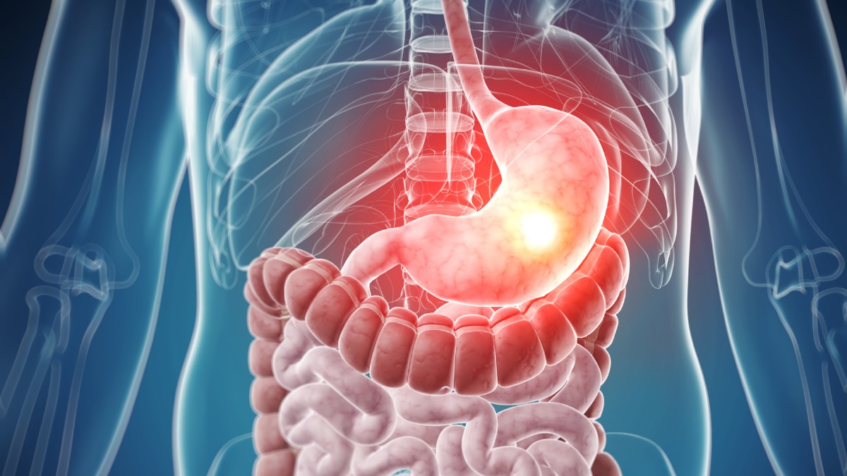 DOR NO estômago COM endoscopia normal: E agora?