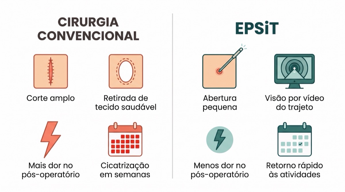 EPSiT, a cirurgia por vídeo que trata o cisto pilonidal sem grandes cortes