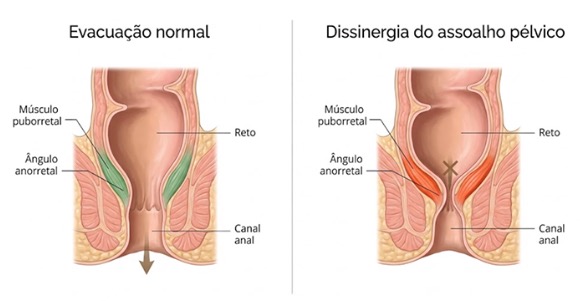 Evacuação incompleta: por que essa sensação acontece e o que fazer a respeito