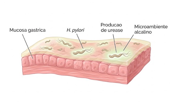 H. pylori: o que mudou no tratamento e como erradicar a bactéria