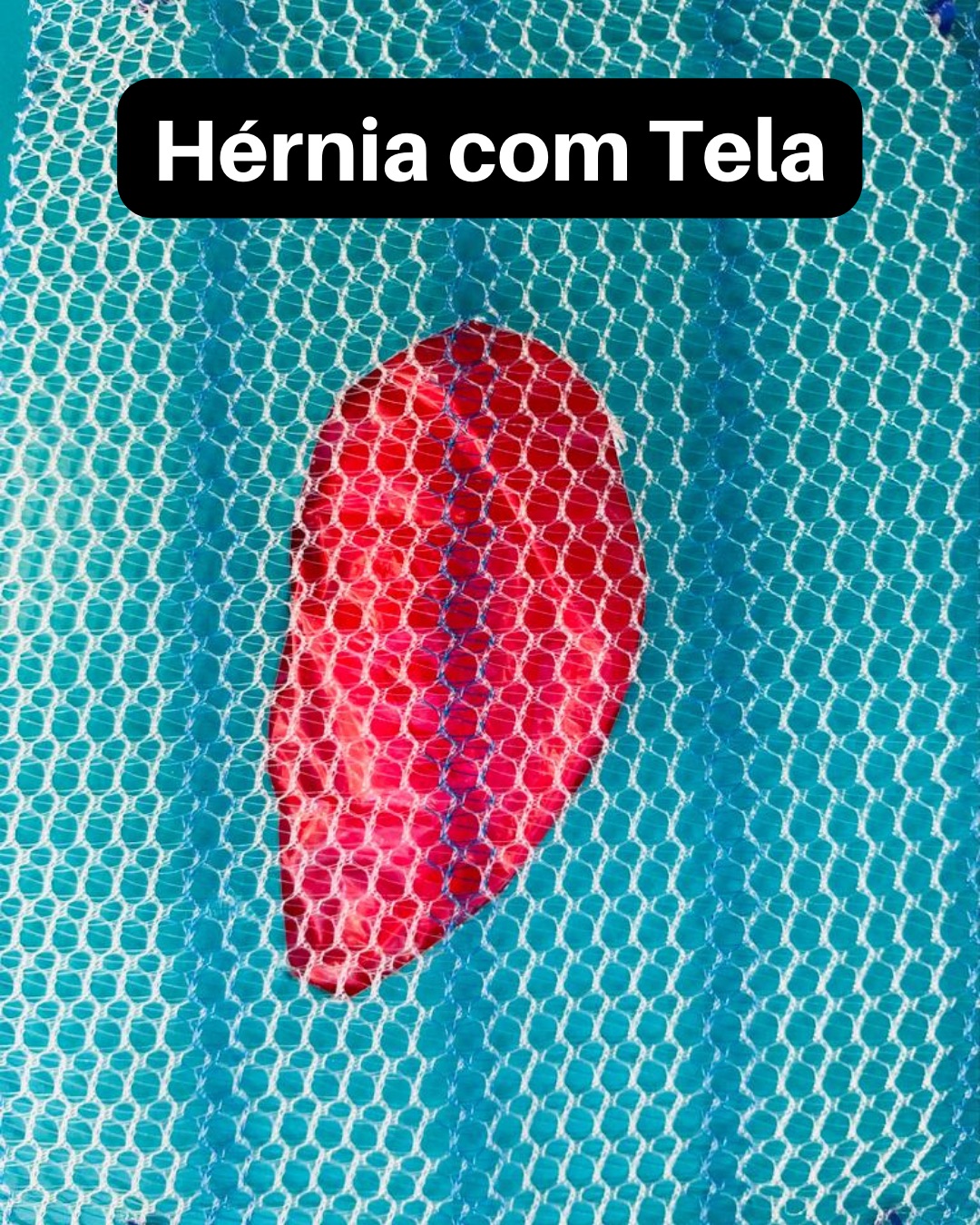 Hérnia inguinal: O QUE É E como tratar