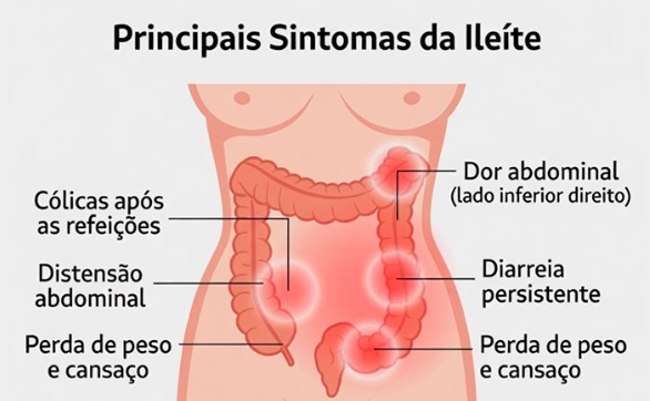 Ileíte: entenda a inflamação do íleo e saiba o que fazer após o diagnóstico