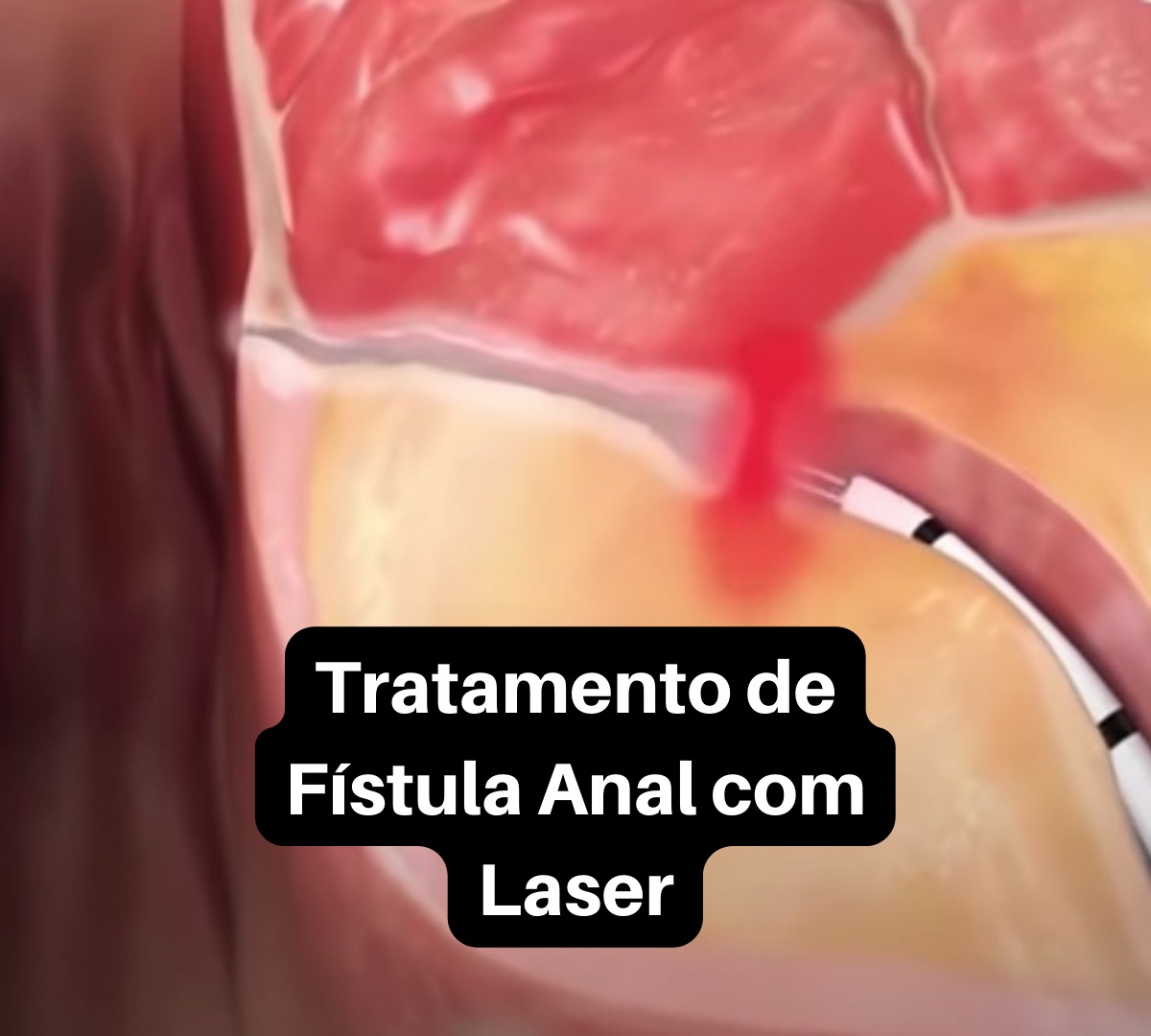 Laser para fístula anal