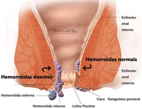Laser para hemorroidas