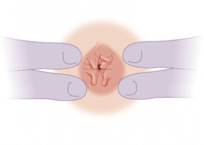 Laser para plicomas anais