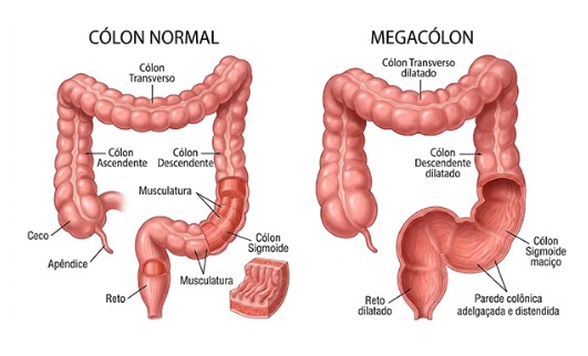 Megacólon: por que o intestino dilata e o que fazer para recuperar o funcionamento