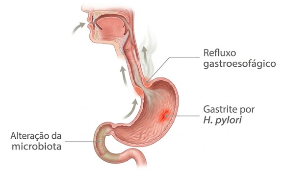 O que causa o hálito ruim e quando ele indica um problema digestivo
