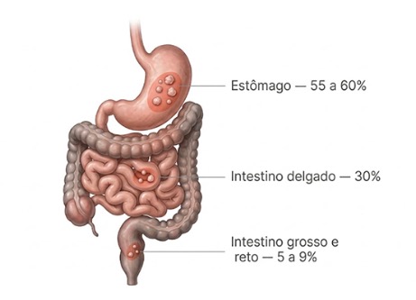 O que é GIST e como esse tumor é diagnosticado e tratado