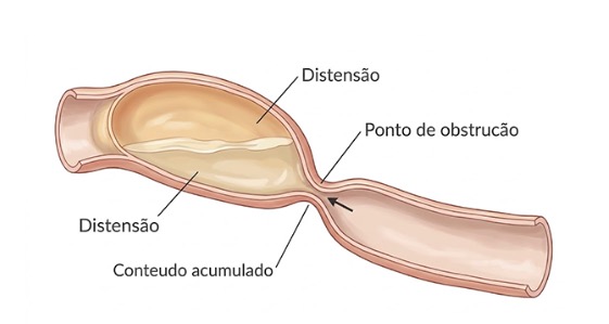 Obstrução intestinal: o que causa, quais os sintomas e como é o tratamento