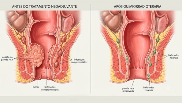 Por que preciso fazer quimioterapia e radioterapia antes de operar o câncer de reto?