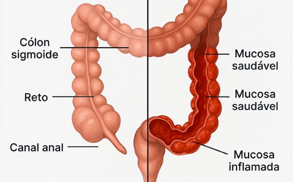 Proctite: o que é, quais as causas e como é feito o tratamento
