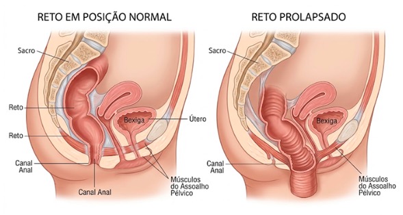 Prolapso retal: da primeira percepção do problema ao tratamento definitivo
