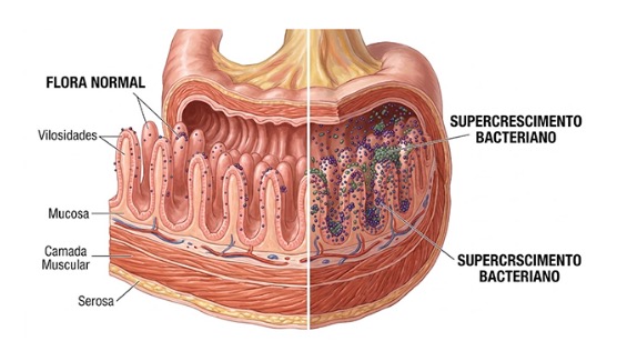 SIBO: entenda o supercrescimento bacteriano no intestino delgado e saiba como tratar