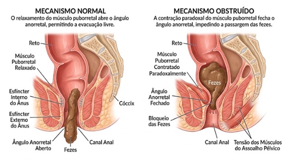 Síndrome da defecação obstruída: quando o problema não é o intestino preso, é a saída
