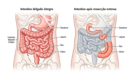 Síndrome do intestino curto: o que muda no corpo após a cirurgia e como se adaptar
