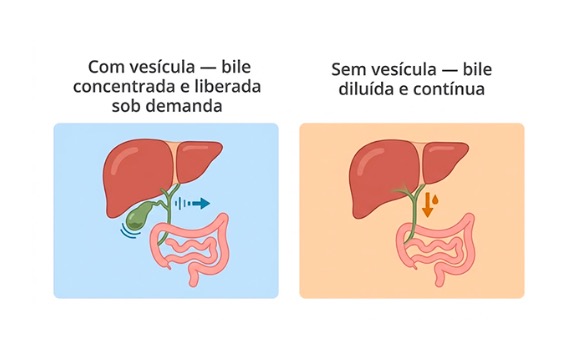 Suplementação pós retirada da vesícula: quais nutrientes merecem atenção