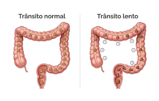 Tipos de constipação intestinal e como cuidar de cada um