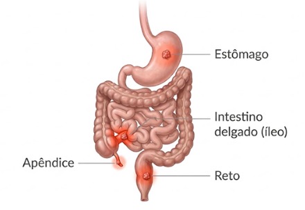 Tumor carcinoide: entenda o que é esse tipo de tumor neuroendócrino