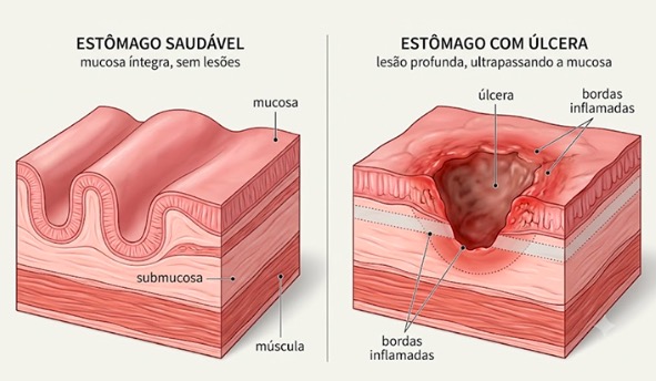 Úlcera gástrica: entenda as causas, os riscos e o caminho para o tratamento