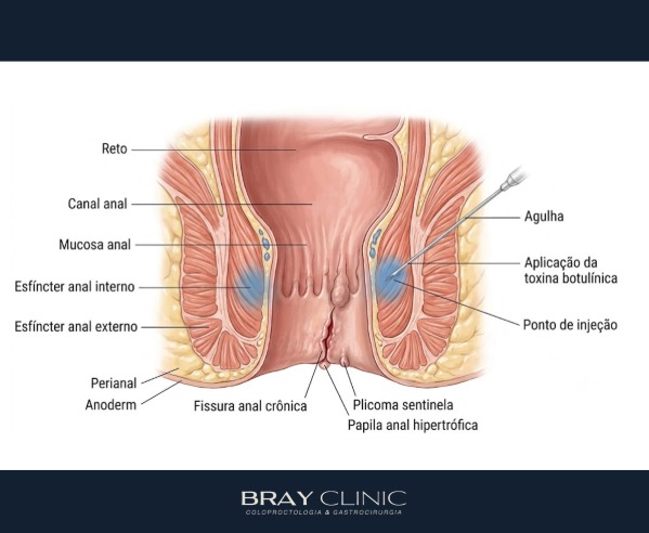 Uso de toxina botulínica na fissura anal: quando o botox é a melhor opção