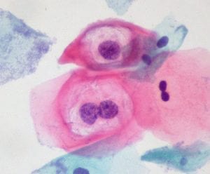 verrugas anais