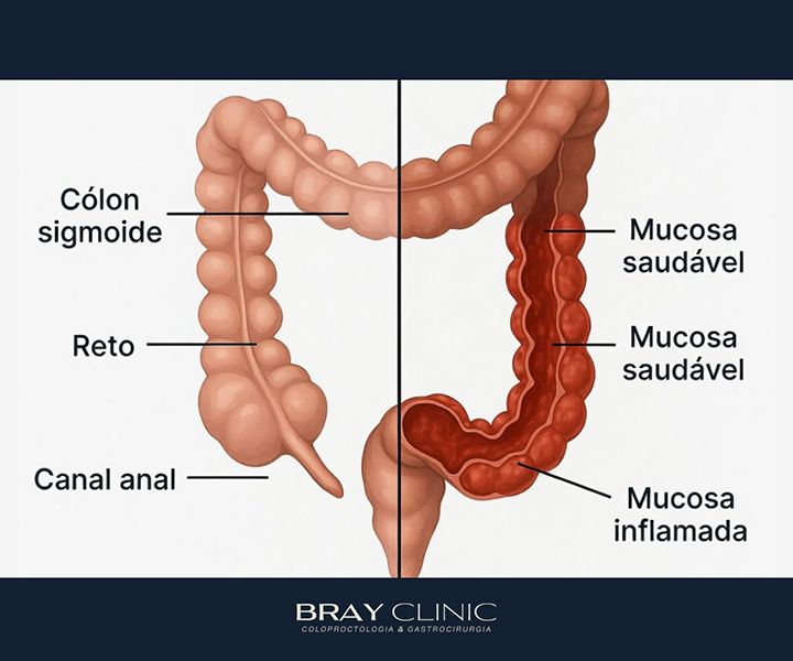 Proctite: o que é, quais as causas e como é feito o tratamento