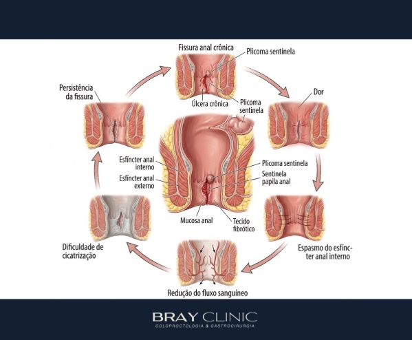Uso de toxina botulínica na fissura anal: quando o botox é a melhor opção