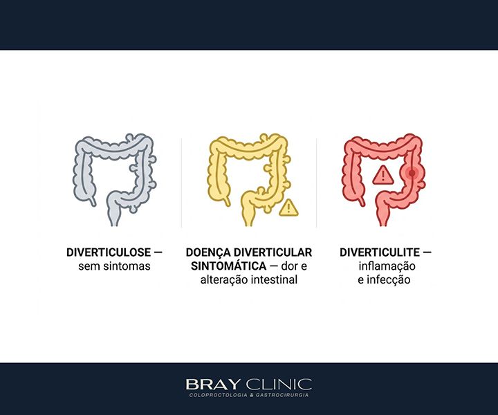 Doença diverticular do cólon: entenda o que são os divertículos e quando eles se tornam um problema