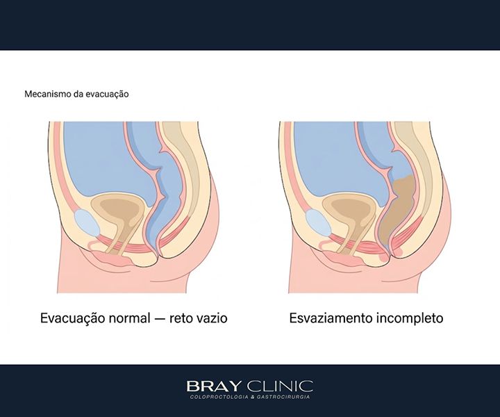 Evacuação incompleta: por que você sente que o intestino nunca esvazia