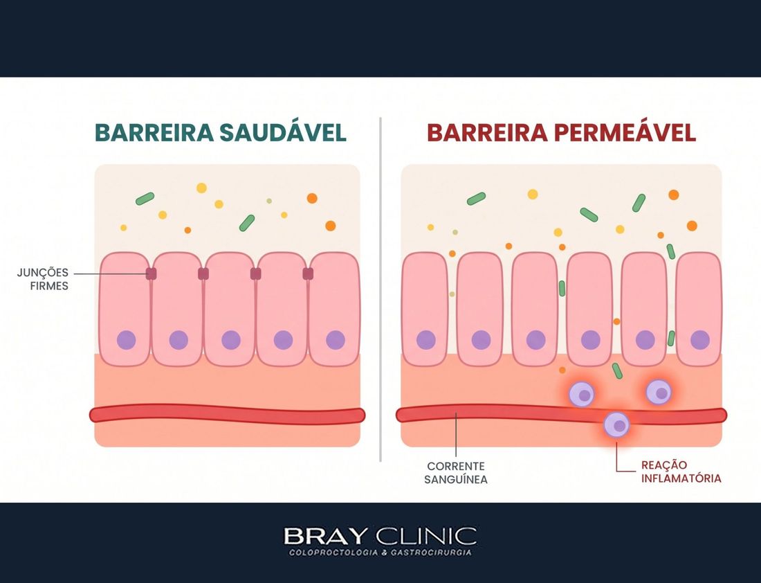 Intestino permeável existe? O que a ciência já sabe sobre o leaky gut e a barreira intestinal