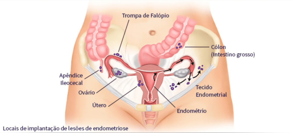 O que é endometriose profunda intestinal e qual o tratamento