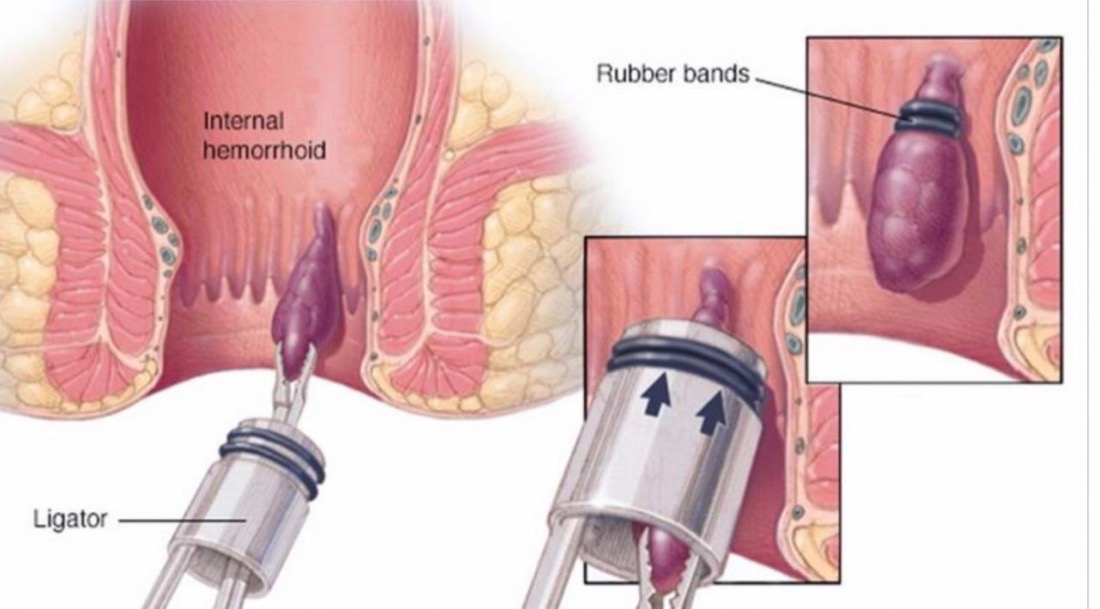 Hemorroidas: tratamento sem cirurgia e como aliviar os sintomas