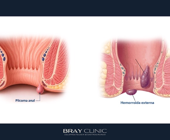 Por que os plicomas anais podem voltar depois da cirurgia?