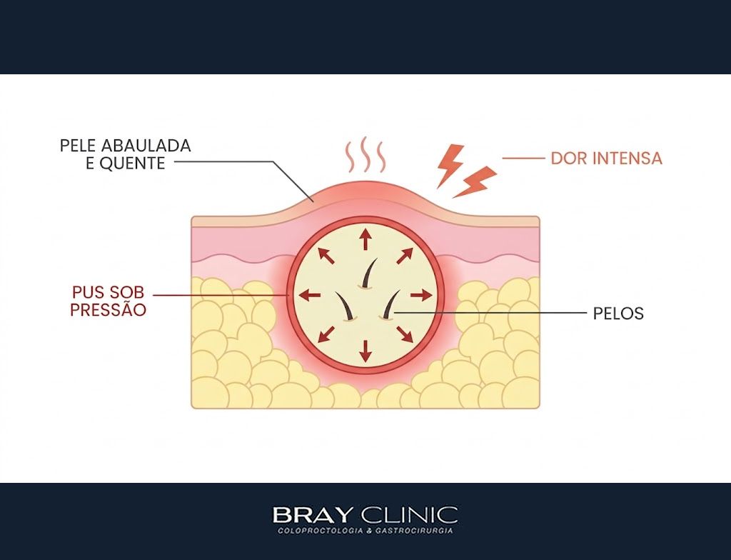 Abscesso pilonidal, entenda a crise aguda do cisto e por que a drenagem vem primeiro