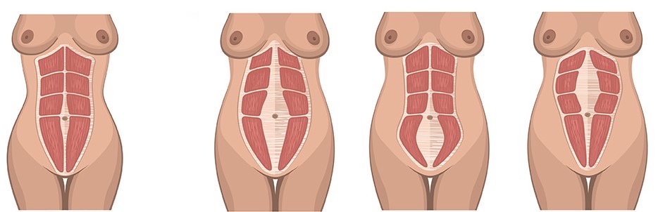 Diástase Abdominal