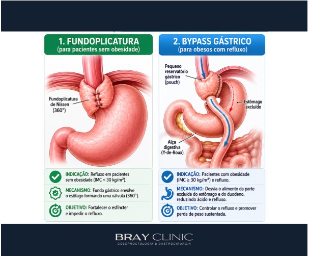 Entenda como é a cirurgia do refluxo gastroesofágico