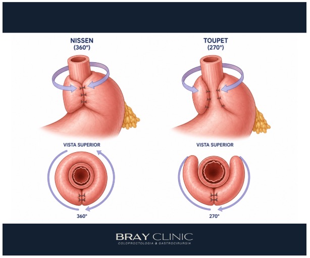 Entenda como é a cirurgia do refluxo gastroesofágico