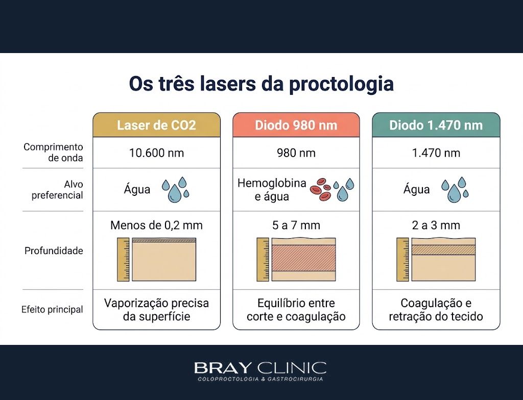 Tipos de laser na proctologia, por que o CO2 e o diodo tratam doenças tão diferentes
