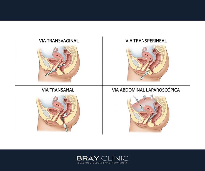 Cirurgia de retocele: o guia completo sobre técnicas, indicação e recuperação