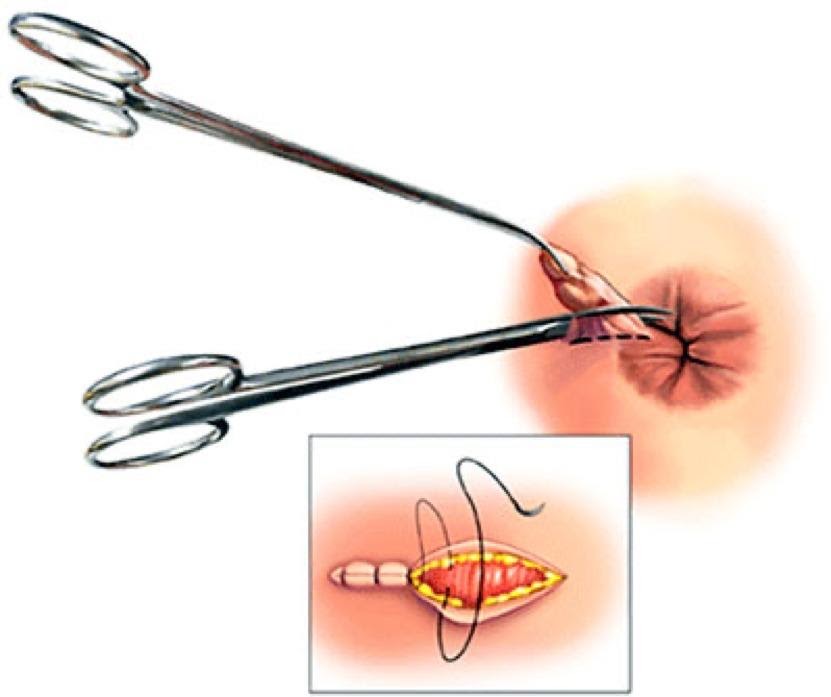 Cirurgia de Plicoma Anal