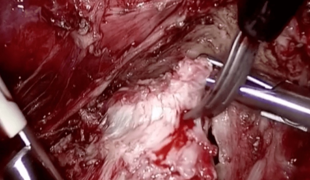 Quais os tipos de cirurgia para endometriose profunda intestinal