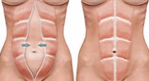 Diástase abdominal não ocorre apenas no pós-parto