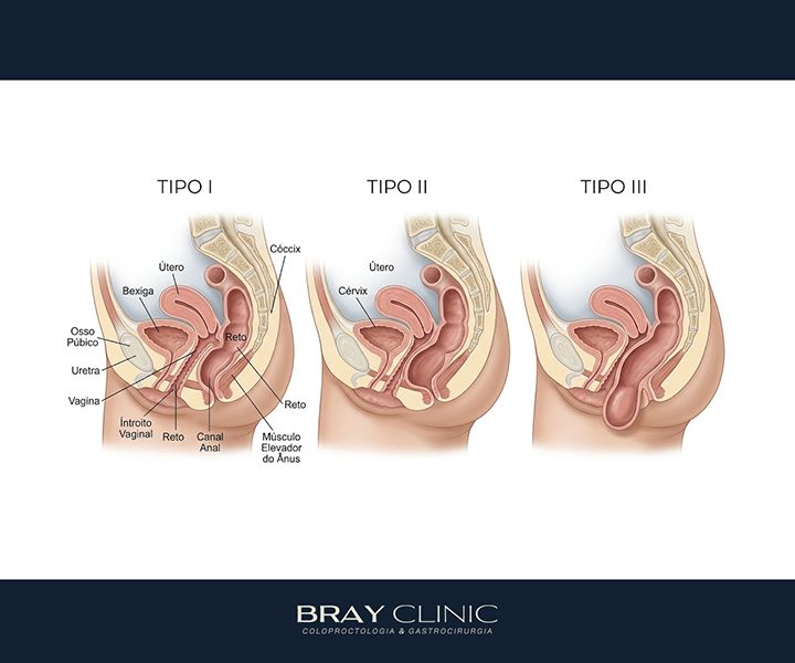 Cirurgia de retocele: o guia completo sobre técnicas, indicação e recuperação