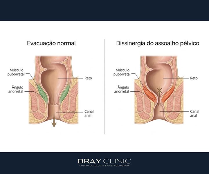 Evacuação incompleta: por que essa sensação acontece e o que fazer a respeito