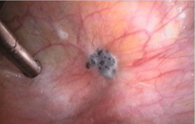 Como diagnosticar e avaliar a endometriose profunda intestinal
