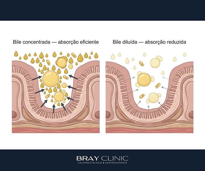 Suplementação pós retirada da vesícula: quais nutrientes merecem atenção