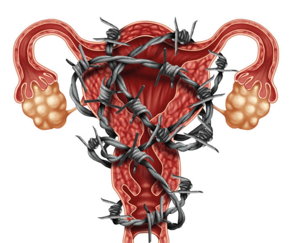 O que é endometriose e quais os sintomas
